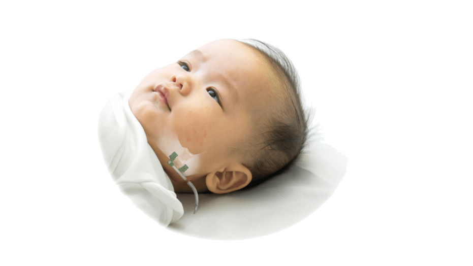 Craniomaxillifacial Distraction system shown on baby
