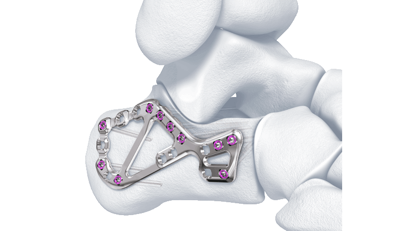 The Variable Angle Locking Calcaneal Plate shown affixed to bones of human heel