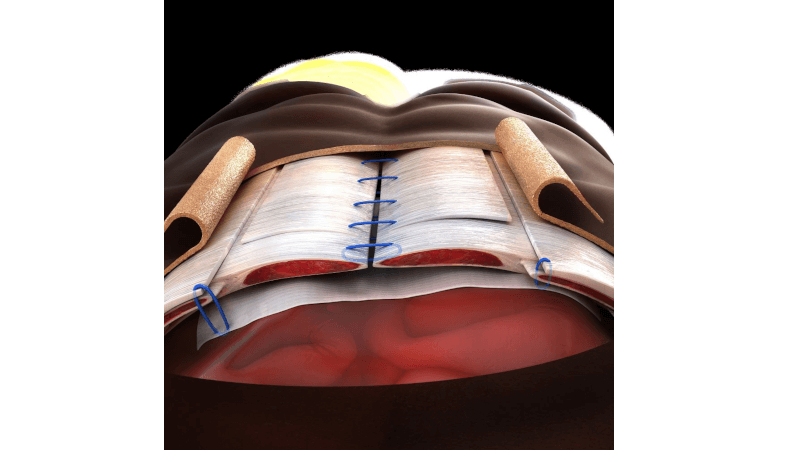 Abdominal Wall Reconstruction using biologic mesh.