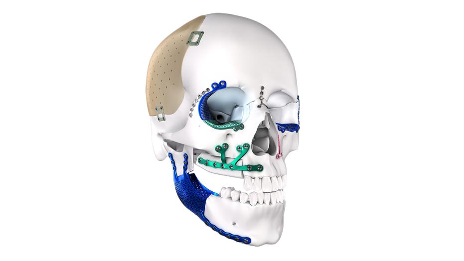 Human skull showcasing various options of the TRUMATCH CMF 3D Printed Implant 