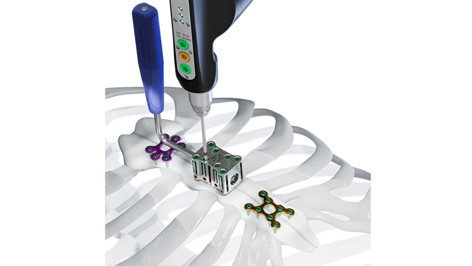 The MatrixSTERNUM Fixation System shown being affixed to bones of sternum 