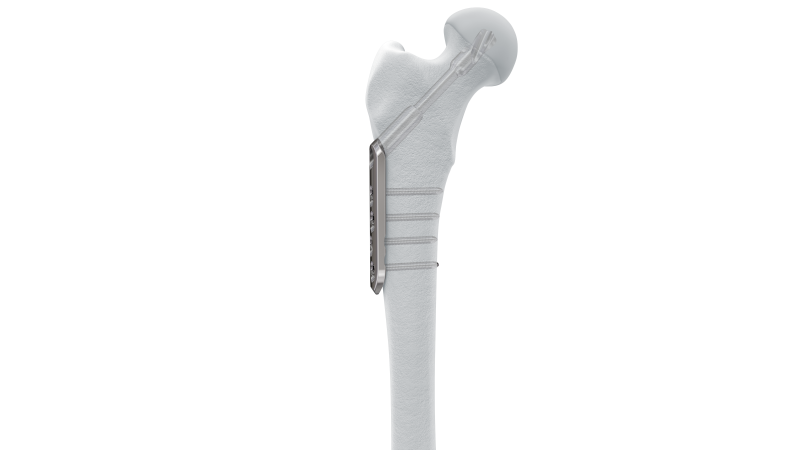 DHS/DCS screw and plate implanted